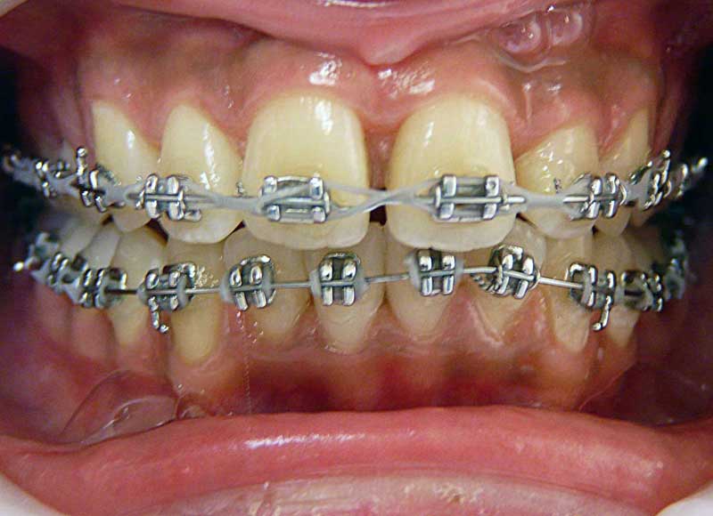 MachouKid Gouttière dentaire pour enfant - Positionnement des dents