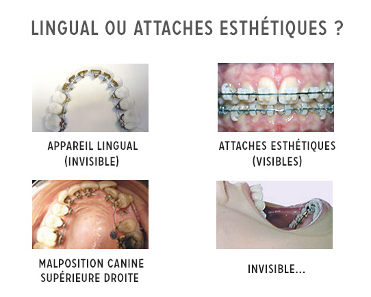 Techniques d'Orthodontie Invisibles : Gouttières et Orthodontie linguale