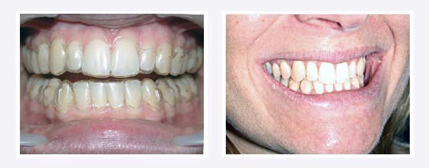 orthodontie adulte exemple de traitement invisalign