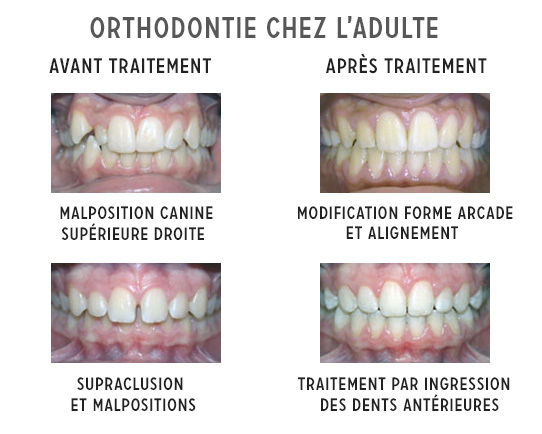 Ingression dentaire - Implantologie. EID Paris
