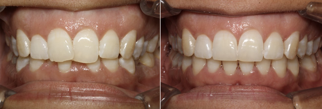 Alignement des dents par gouttières transparentes Marcheprime
