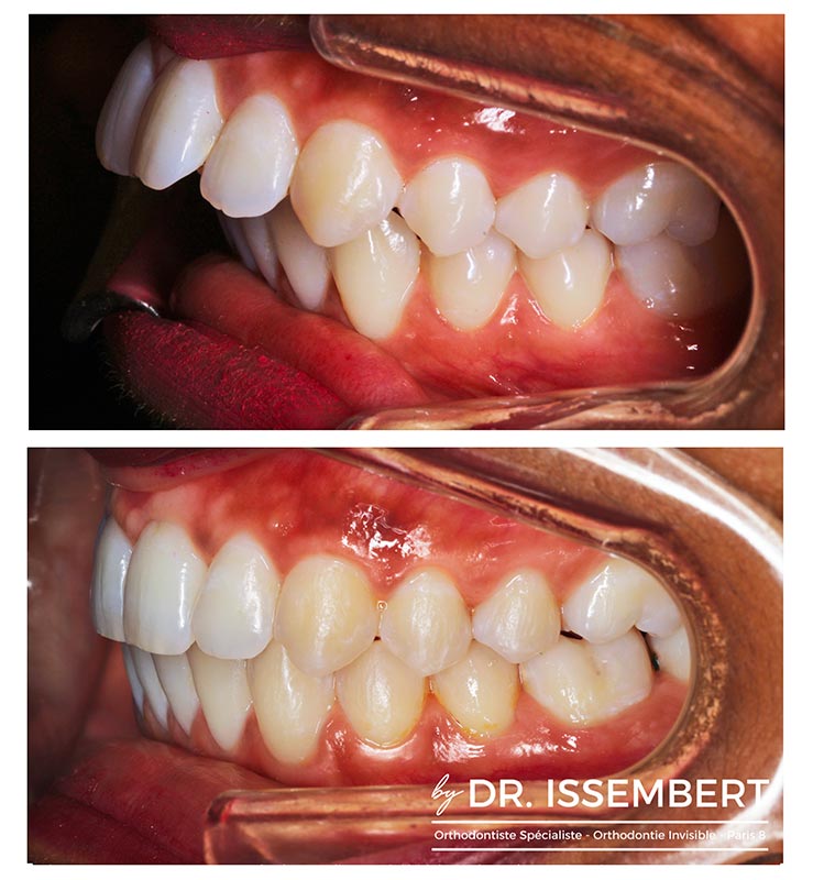 orthodontie invisalign possible dans quels cas explications dr issembert